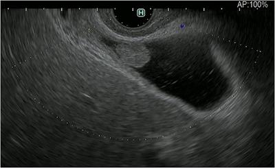 The usefulness of endoscopic ultrasound in the diagnosis of gallbladder lesions